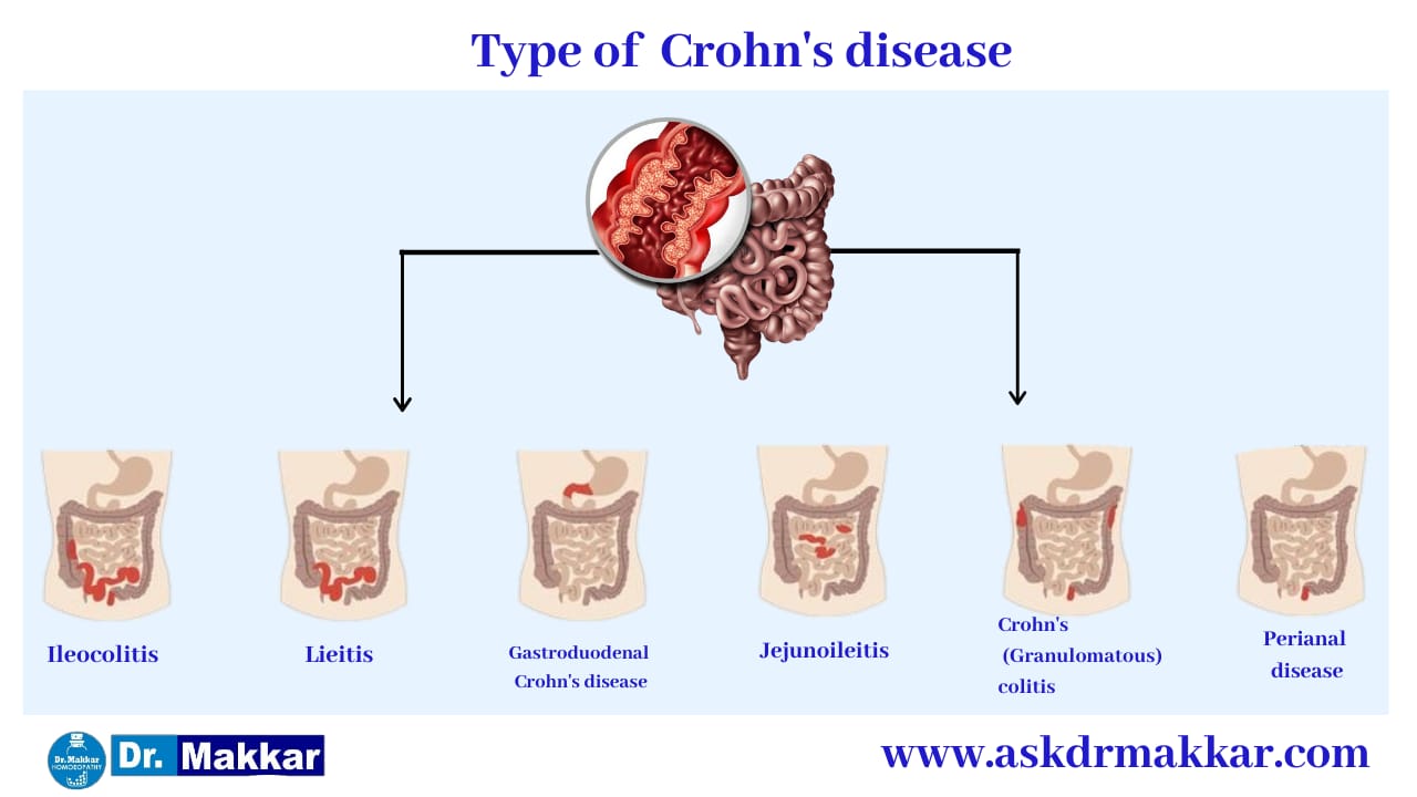 Crohns Homeopathic Treatment